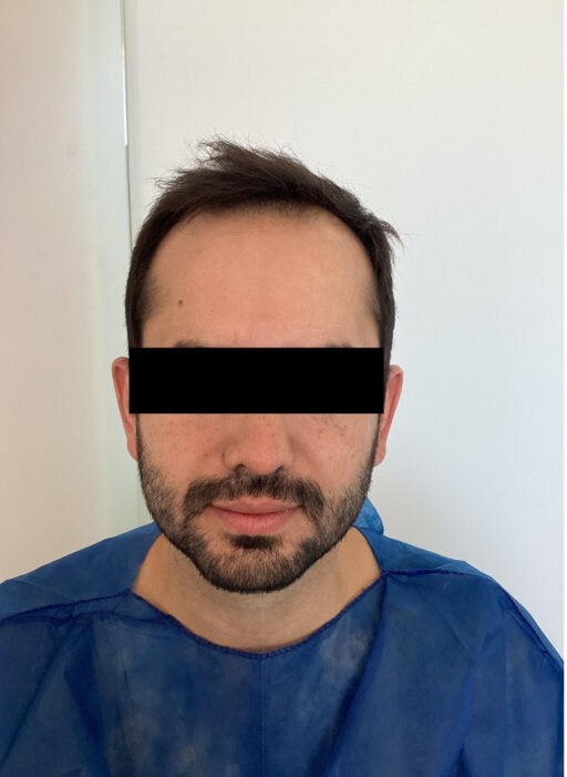 Antes