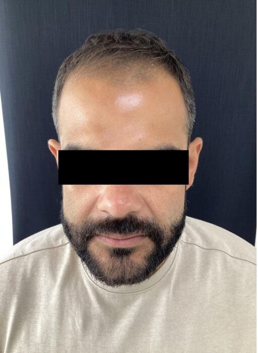 Antes